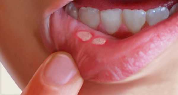Как лечат пародонтоз в стоматологических клиниках? профилактика и симптомы пародонтоза