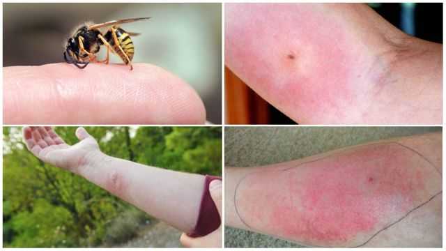 Аллергическая реакция на укус пчелы, что делать