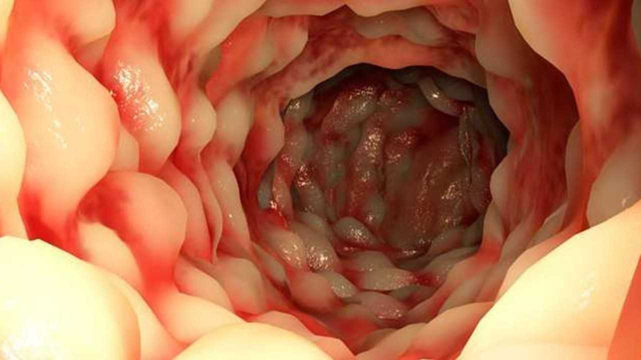 Diverticulosis del intestino delgado
