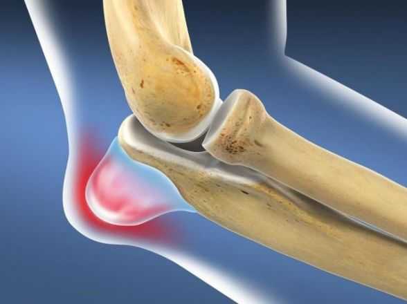 Что такое бурсит колена и как его лечить