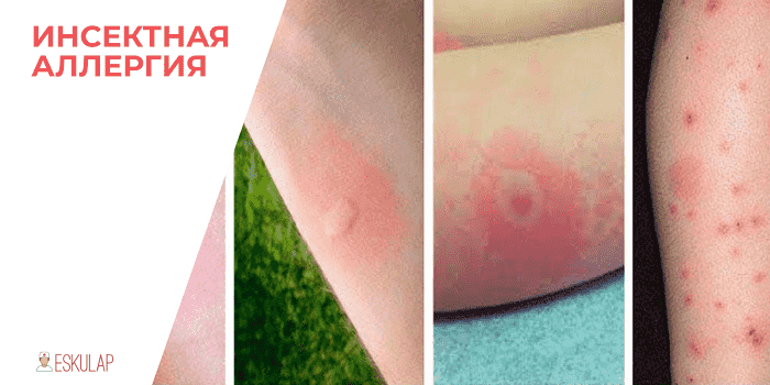 Аллергия на укусы насекомых: симптомы, лечение, последствия — онлайн-диагноз