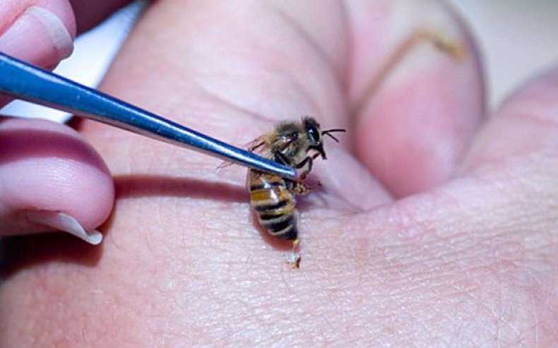 Апитерапия — лечение укусами пчел