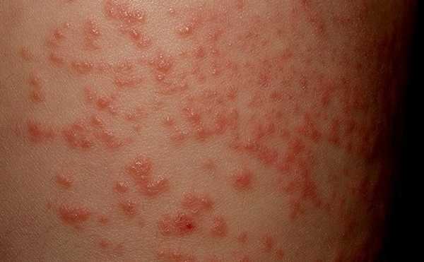 Как отличить аллергическую сыпь от инфекционной