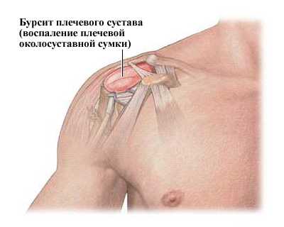 Лечение бурсита плечевого сустава (воспаление синовиальной сумки плеча)