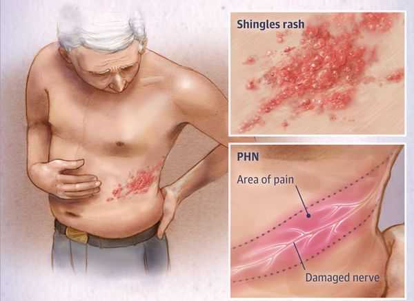 Проявления коронавируса: какие высыпания на коже должны насторожить :: здоровье :: рбк стиль