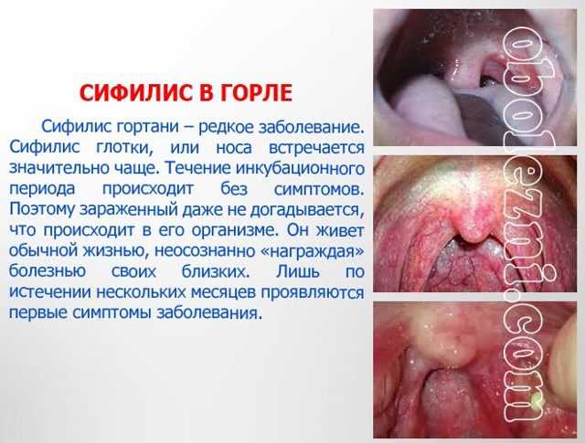 Сифилис глотки и полости рта