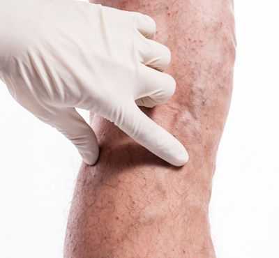 Атеросклероз нижних конечностей: причины, симптомы, диагностика и лечение оа артерий ног