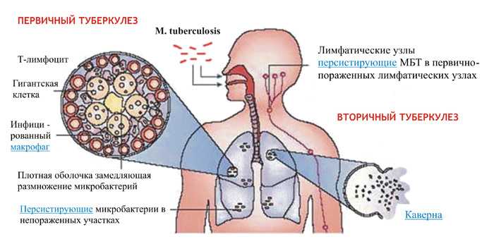 Туберкулез