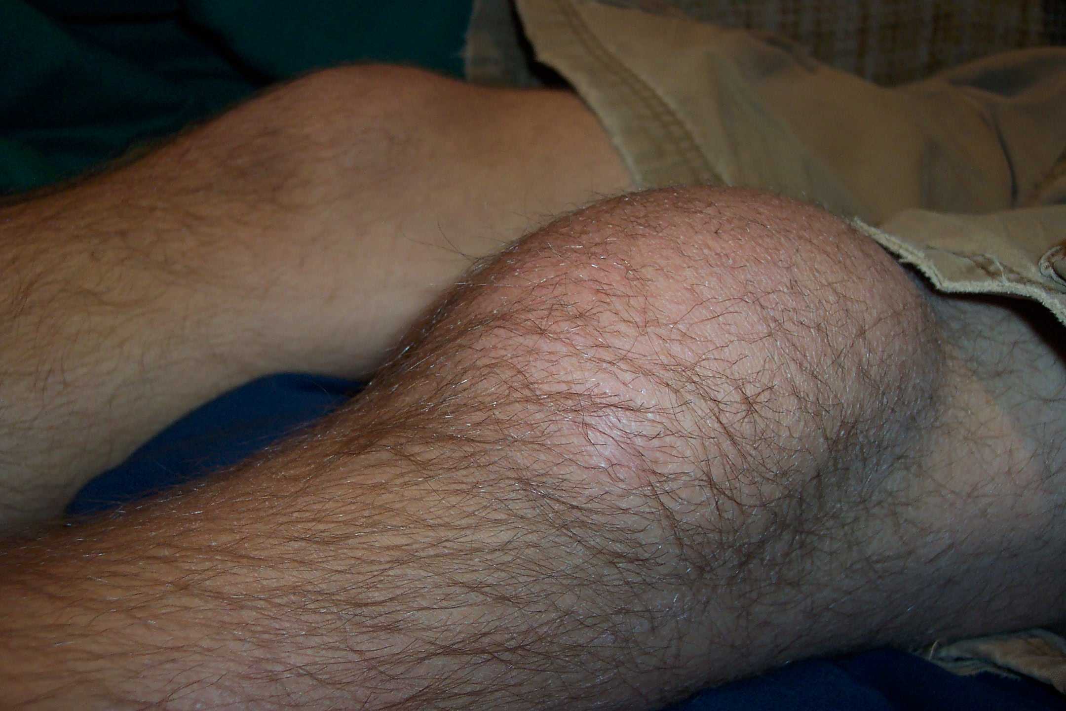 Что такое бурсит колена и как его лечить