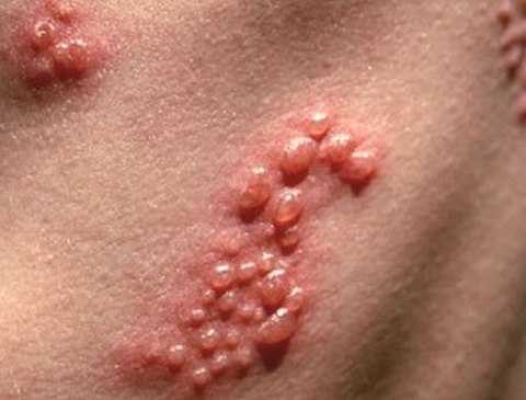 Рожистое воспаление кожи: причины, симптомы и лечение