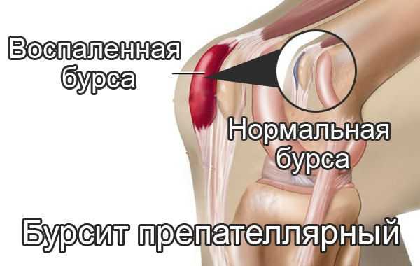 Препателлярный бурсит                (колено горничной)