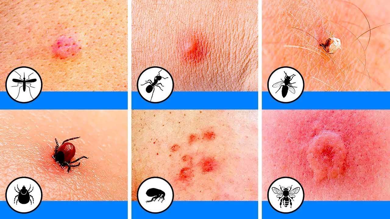 Виды укусов: укусы насекомых, животных. лечение, последствия