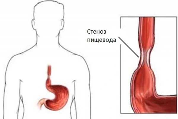 Как избавиться от глистов и других паразитов? отвечает врач-инфекционист