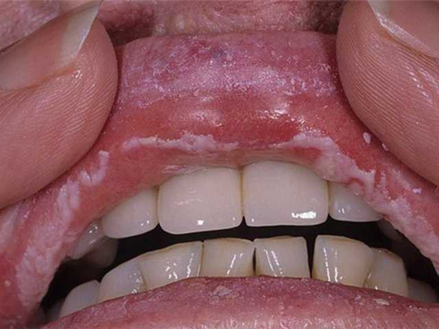 Камистад – скорая помощь при зубной боли