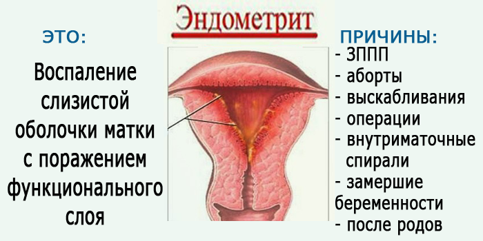 Воспаление внутренней оболочки матки. Острый эндометрит матки. Острый эндометрит симптомы. Эндометрит воспаленный. Острый и хронический эндометрит.