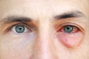 Борьба с паразитами глаз у крс